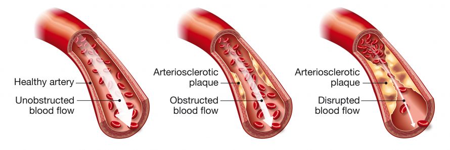 Atherosklerose